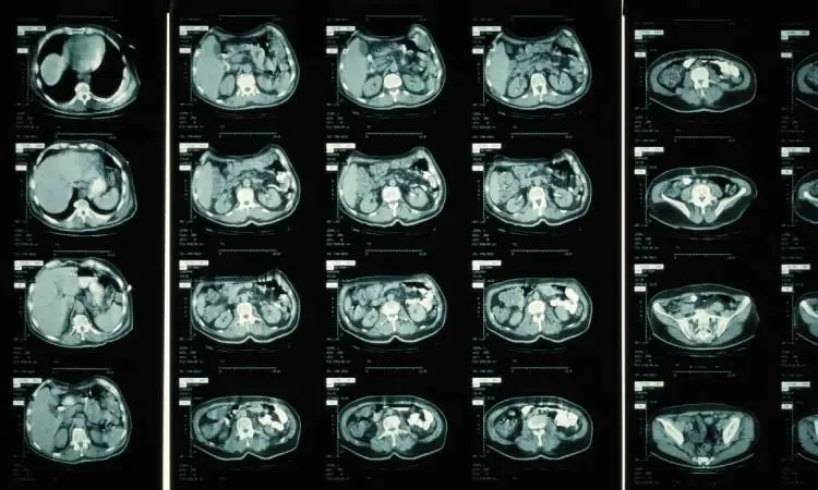 Unlocking Diagnostic Power What Types of Diseases Can Be Detected by a CT Scan